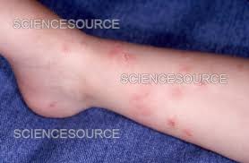 Image result for flea bite