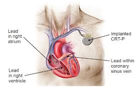Today's pacemakers and other implantable ep devices are to earlier versions what smart 22 management of icd device and lead failures and recalls 207 yousef bader and n.a. How Crt P And Crt D Devices Work Boston Scientific