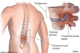 можно ли делать массаж при грыже шейного отдела позвоночника Hirurg Otgovoril Menya Ot Operacii I Posovetoval Delat Etu Zaryadku I Ved Pomoglo Zdorove Uprazhneniya Uprazhneniya Dlya Spiny