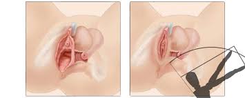 Il peut néanmoins rompre sans rapport, en exerçant des activités sportives comme l'équitation ou le cyclisme par exemple. Redevenir Vierge Grace A L Hymenoplastie Reconstruction De L Hymen