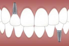 Discomfort may be felt in the chin, cheeks, or underneath the eyes. My Dental Implant Fell Off Now What Dental Town Dc Cosmetic Dentists