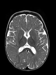 Image result for Kernicterus