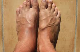 Phytothérapie retention d'eau , retention d'eau phytotherapie , retention d'eau. Chevilles Gonflees 5 Remedes Naturels Ameliore Ta Sante