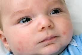 This is a condition marked by a low number of red blood other causes, red spots on the skin can occur due to allergic reactions such as purpura allergic. Petechiae In Babies Causes Signs Diagnosis And Treatment