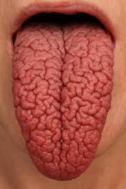 Image result for Fissured tongue