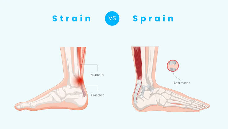 Sprains & Strains