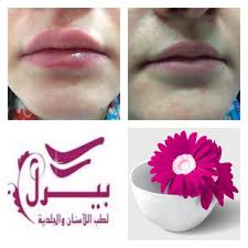 حقن الفيلر لتعبئة و تحديد الشفاه الصور قبل وبعد الحقن الصورة تم تصويرها على احدى الموظفات