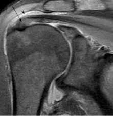 Image result for Shoulder MRI