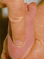 Image result for Capillary Refill