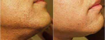 Apply this to the affected area and gently massage it on the affected areas. Facial Hair Removal Philadelphia For Women And Men Main Line Pa