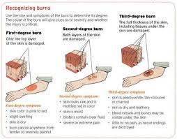 How To Treat A Burn Ent Wellbeing Sydney Burns Nursing Burn Injury Wound Care