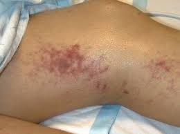 Image result for Panniculitis