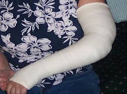 Image result for Long Arm Cast