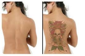 Best tattoo removal creams : Laser Tattoo Removal By Lose Your Ink