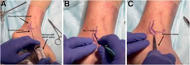 Image result for Tendon Sheath Injection