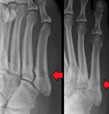 They are more common in children than adults, but often affect adults who. Jones Fracture Wikipedia