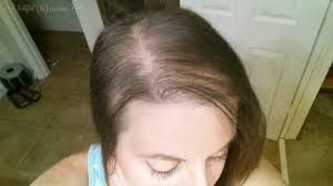 Postpartum hair loss (alopecia) postpartum hair loss, or alopecia, presents as increased shedding of scalp hair. Damn You Post Partum Shed Photo