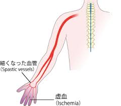 「冷えの影響で手足の血管が縮んでいる」の画像検索結果
