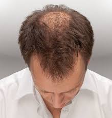 5 idées reçues sur la calvitie chez l'homme. Efficacite Prouvee Debut De Calvitie Test Jr Prestations