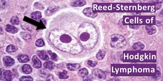 Kathleen D Hoffman On Twitter Hodgkin S Lymphoma Non Hodgkin Lymphoma What S The Difference Https T Co Elnnyzngrh