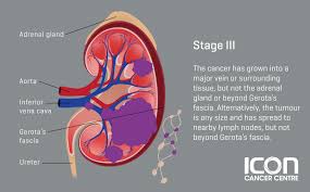 Kidney cancer represents about 3.7 percent of all cancers in the stage iii: Kidney Cancer Icon Cancer Centre Singapore
