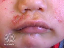 Image result for Impetigo