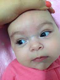 Blue Vein Across Babes Nose March 2014 Babycenter Canada