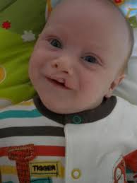 Ben Hurd is fundraising for Cleft Lip And Palate Association