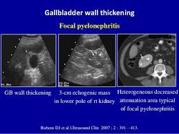 Gallbladder Wall Thickening Rubens Dj Et Al Ultrasound Clin 2007 2 391 413 Focal Pyelonephritis Heterogeneous Decre Ultrasound Chronic Gallbladder