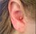 Ear Canal Pimple In Ear