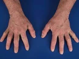 Image result for scabies norvegica