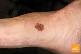 This is most common in the big toes of your feet. Did You Know You Can Get Malignant Melanoma On Your Feet Sutherland Podiatry