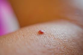 How To Remove Red Moles On Skin 2020 Guide Ferguson Action 2020