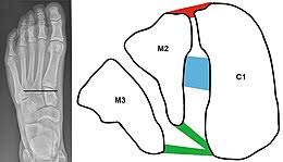 A lisfranc injury describes an injury of the foot between the metatarsal and tarsal spaces. Lisfranc Injury Wikipedia