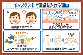インプラント治療の仮歯はいつまで？生活での注意点も解説｜いのうえまさとし歯科ブログ