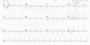 In #nstemi patients, is it better to give p2y12 inhibitors prior to or after angiography? Myocardial Ischaemia Litfl Ecg Library Diagnosis
