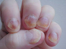 The ointment also soothes itching and burning that can come with an infection, all while healing the skin. best soak: Tea Tree Oil For Fingernail Fungus Tea Tree Oil Uses About Tea Tree Oil About Tea Tree Oil