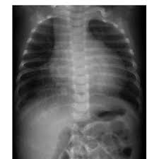 Initial Chest This Initial Chest X Ray Shows An Apparent Cardiomegaly Download Scientific Diagram