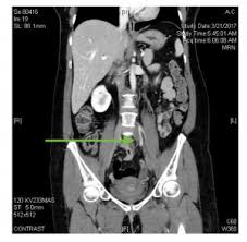 Emdocs Net Emergency Medicine Educationa Case Of Rare Cause Of Dvt In The Young Healthy Patient Emdocs Net Emergency Medicine Education
