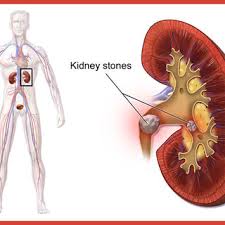 Pdf Double J Stenting And Stone Disease