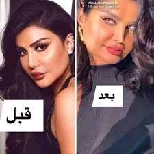 يختلف حكم عمليات التجميل باختلاف نوعها، وفيما يأتي بيان الأنواع، وحكم كلّ نوعٍ:٤. Ø¹Ù…Ù„ÙŠØ§Øª Ø§Ù„ØªØ¬Ù…ÙŠÙ„ Ø§Ù„ÙˆÙ‡Ù…ÙŠØ© Ø£Ù…Ù„ Ø§Ù„Ø¹ÙˆØ¶ÙŠ Ù‚Ø¨Ù„ Ø§Ù„Ø¹Ø±ÙˆØ³Ø© Ø§Ù„Ù…ØµØ±Ø§ØªÙŠÙ‡ Facebook