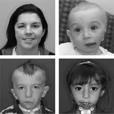 TESIS: REVISIÓN GENERAL DE ASPECTOS ORTODÓNCICOS, ORTOPÉDICOS Y QUIRÚRGICOS  DE LA MICROSOMÍA HEMIFACIAL