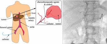 The liver region is further segmented using localized contouring. Continuous Roadmapping In Liver Tace Procedures Using 2d 3d Catheter Based Registration Springerlink