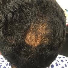 Olanzapine should not be used to treat behavioral problems in older adult patients who have dementia or alzheimer's disease. Pdf Teneligliptin Induced Hair Loss A Case Report