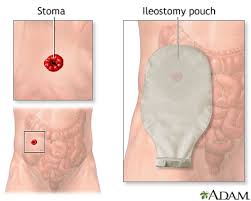 A more detailed video will be coming soon (subscribe to know. Ileostomy Changing Your Pouch Information Mount Sinai New York