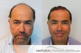 Natural Transplants, Hair Restoration Clinic, 2601 E Oakland Park Blvd, Ste  400, Fort Lauderdale, FL 33306, US