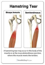 Tendons and ligaments are bands of connective tissue that help stabilize the body and allow movement. Hamstring Muscle Tear And Tendon Tear Hamstring Muscles Muscle Tear Torn Hamstring