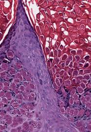 Tuberculosis types of infection and reaction dr sameh ghazy. Nocardiosis Clinical And Pathological Aspects Intechopen
