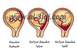 اسباب نزول المشيمه وعلاجها احلى بنات