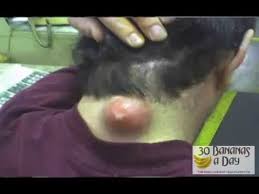 Pimple popper fan, in addition to the endless entertainment factor, is the ability to shock your friends and family with how much medical terminology you've picked up along the way. Biggest Zit On Planet Earth Warning Most Disgusting Version 316 Youtube